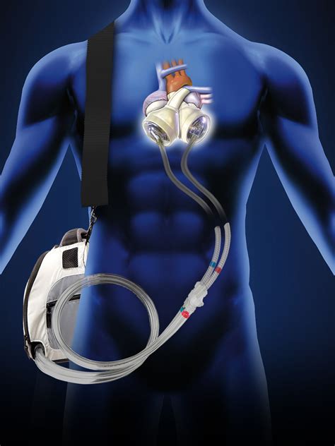 syncardia total artificial heart cost.